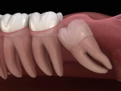 Diagram of teeth in need of extraction in Paradise