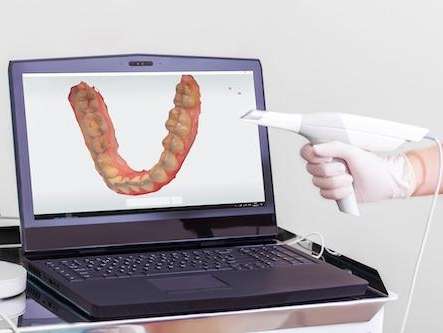 close up of computer with digital mouth impression | dentist las vegas nv